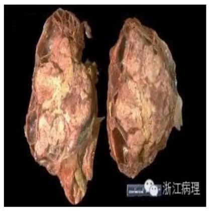新近认识的肾细胞癌