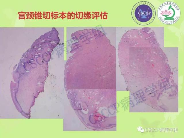 宫颈与子宫病变病理标本取材