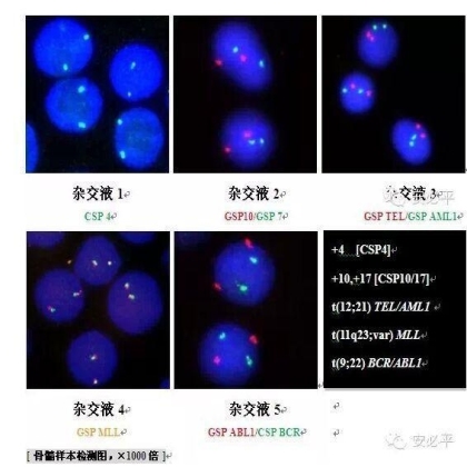 急性淋巴细胞白血病(ALL)染色体及基因异常检测试剂盒(FISH)-诊断分型、预后判断、病情监测