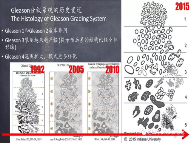 AJCC第8版 前列腺癌分期 之 病理学要点