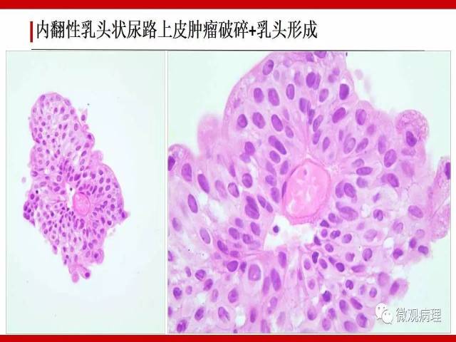 膀胱尿路上皮肿瘤诊断的一些困惑