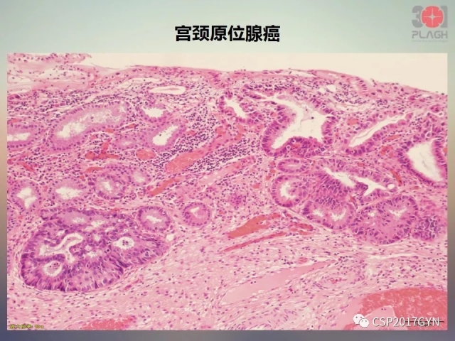 宫颈腺癌的临床病理研究进展