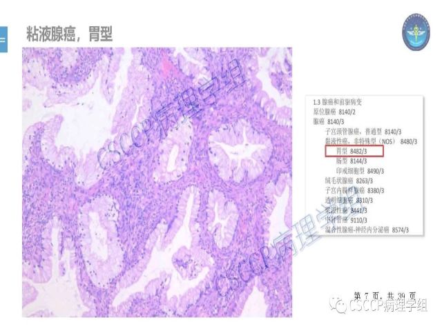 黄文亭 张询：宫颈腺癌分类介绍