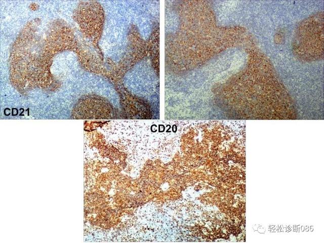 HIV/AIDS相关性LPDHIV感染相关淋巴瘤病例分析