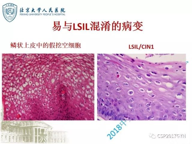 宫颈鳞状上皮内病变病理诊断中问题