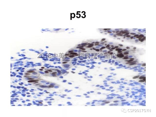 子宫内膜假肿瘤性病变及类似癌样病变