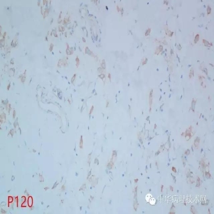 免疫组化结果的分析和常见问题的处理