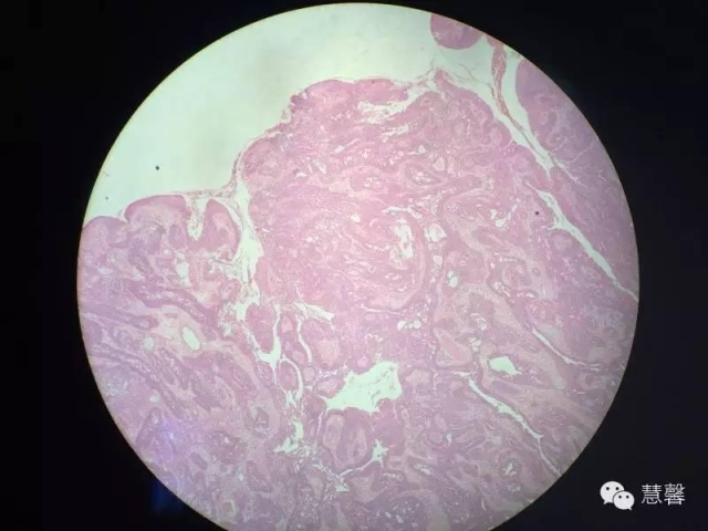 乳头状汗管囊腺瘤诊断及取材相关问题（迟悟分享，孔祥田及于励民老师讲解）