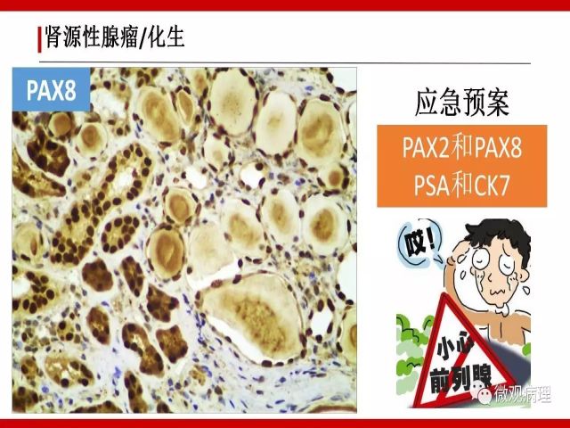 泌尿课程/尿路腺样病变的诊断要点