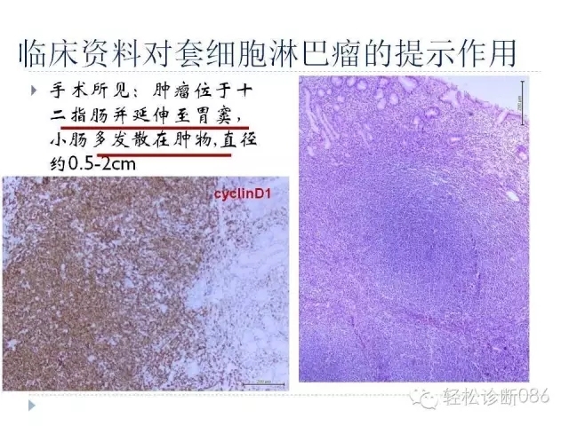 关于套细胞淋巴瘤的总结课件