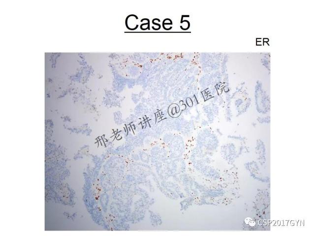 典型妇科病理病例的探究与分析