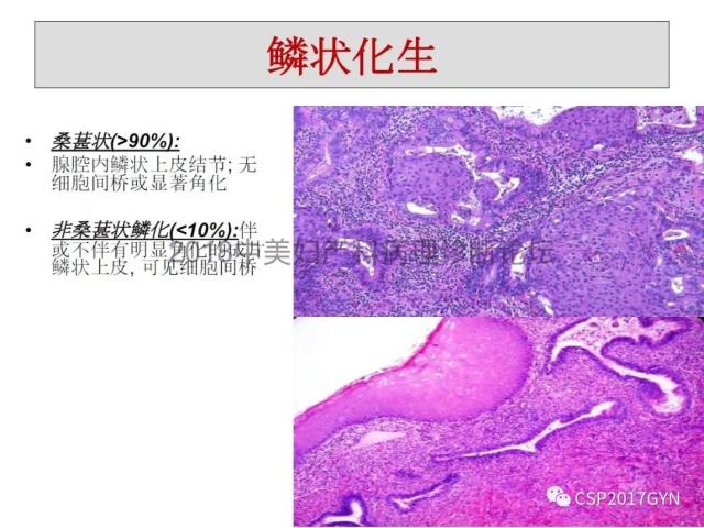 子宫内膜假肿瘤性病变及类似癌样病变