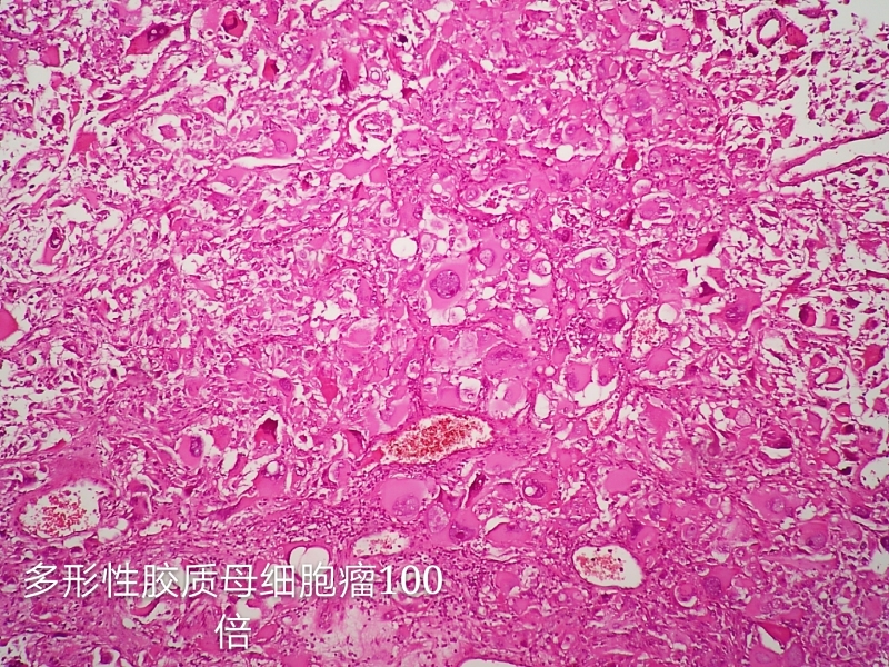 病理科工作札记（三十八）胶质母细胞瘤