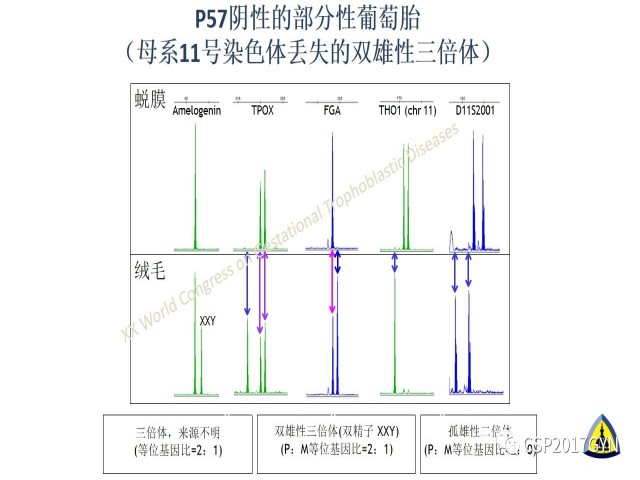 p57免疫组化染色及基因分型 在葡萄胎精确诊断中的应用