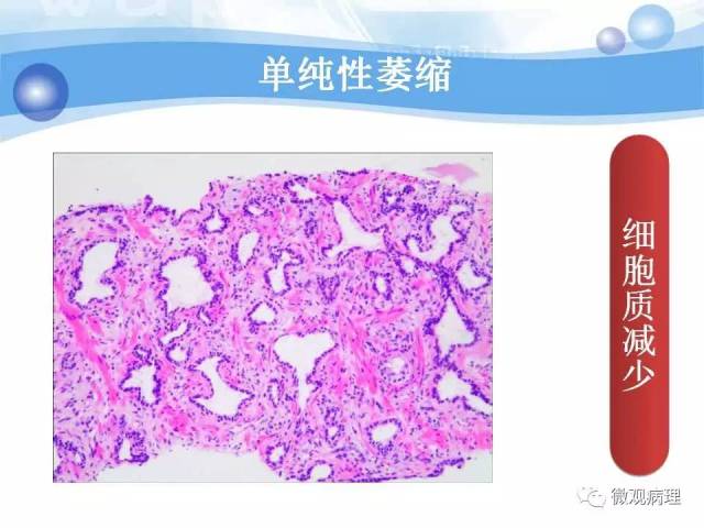泌尿课程/局灶性前列腺萎缩