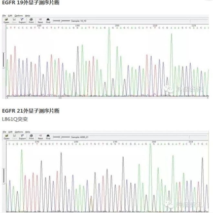 中日韩个体化诊疗案例大赛经典赏析之四——驱动基因主导的个体化精准治疗实践，EGFR L861Q少见突变临床实例