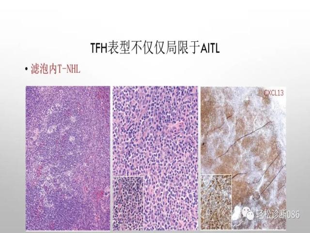 血管免疫母T细胞淋巴瘤的病理诊断