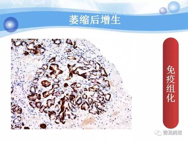泌尿课程/局灶性前列腺萎缩