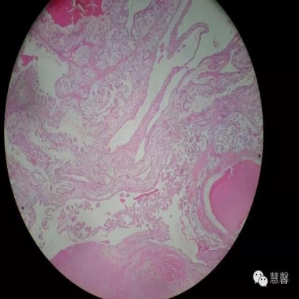 透明细胞乳头状肾细胞癌？TFE3 Traslocation Carcinoma？（赵洋分享，孔祥田(Max)*NM老师讲解）