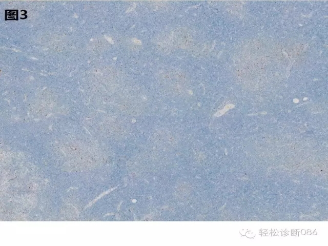 小B细胞非霍奇金淋巴瘤——慢性淋巴细胞白血病(2)