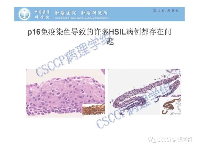 宫颈癌前病变中的诊断难点及阴道镜中ECC的 应用价值