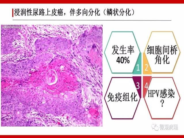 泌尿课程/浸润性尿路上皮癌病理学类型