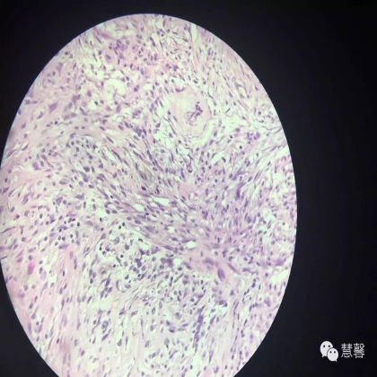 乳腺叶状肿瘤诊断（慧馨分享，孔祥田(Max)*Roswell*NM老师讲解）