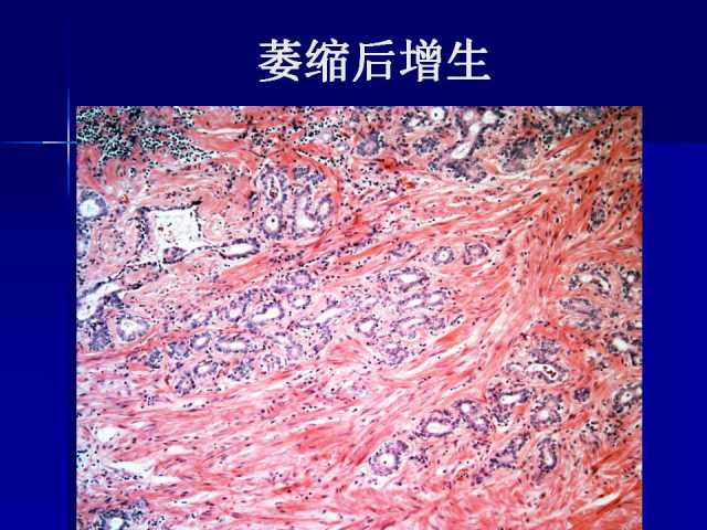 前列腺病理诊断线索（下）——黄教悌
