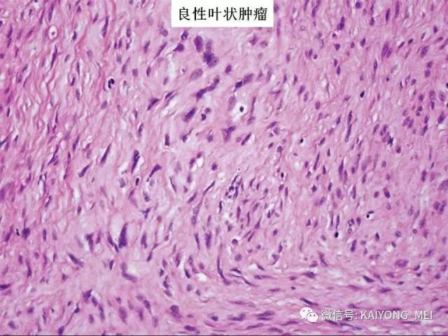 乳腺梭形细胞病变的病理诊断及进展（二）