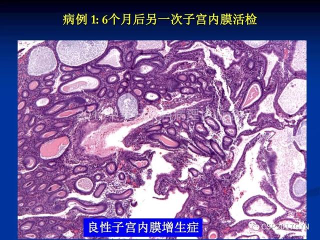 子宫内膜癌：诊断与进展