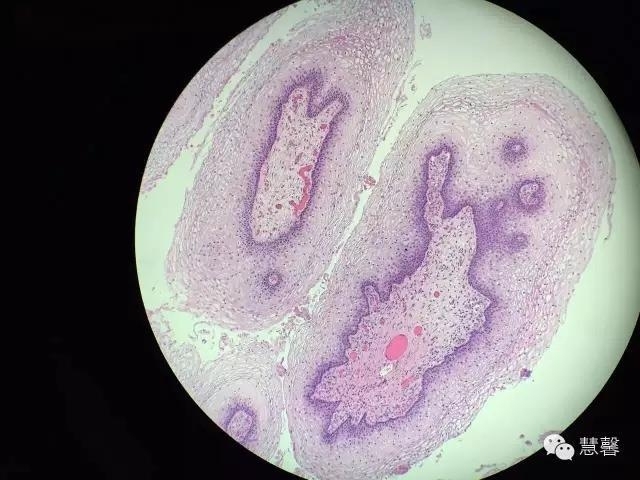 阴道鳞状上皮乳头状瘤？尖锐湿疣？（孔祥田老师病例分享，粉蓝医疗科技（杭州）有限公司女性生殖2群讨论，孔祥田(Max)*Roswell*老师讲解）