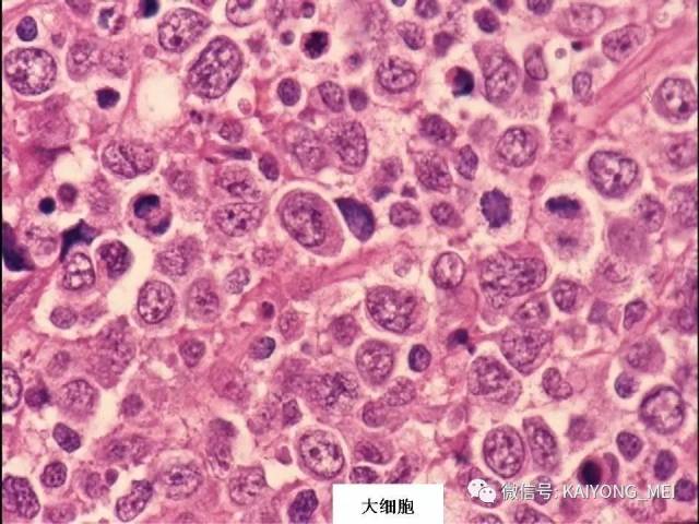 T细胞淋巴瘤病理诊断及进展（三）