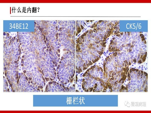 泌尿课程/尿路上皮病变的基本生长方式