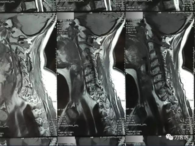 医生及患者通用:如何用手机翻拍X线片,磁共振片子,CT片子进行网络求医、病例讨论及保留资料 医生及患者通用:如何用手机翻拍X线片,磁共振片子,CT片子进行网络求医、病例讨论及保留资料