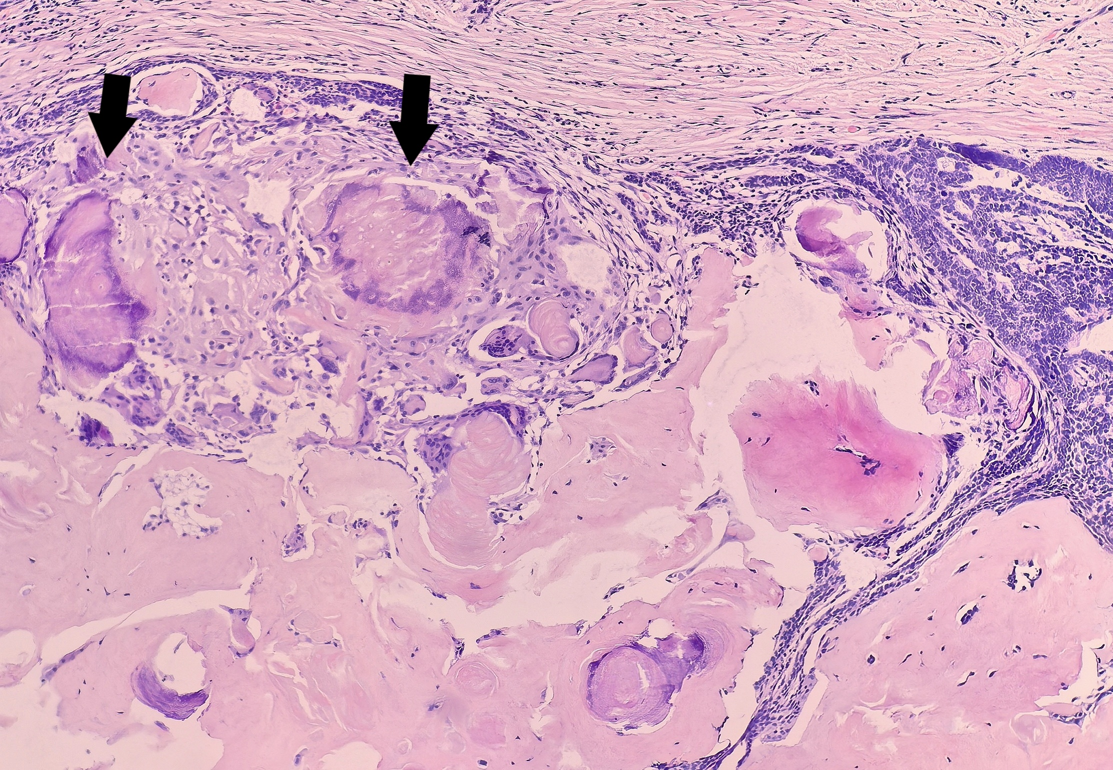 皮肤基底细胞癌伴骨样基质形成一例
