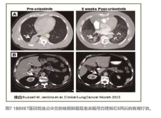 原发MET基因扩增型肿瘤“METoma”与精准医学