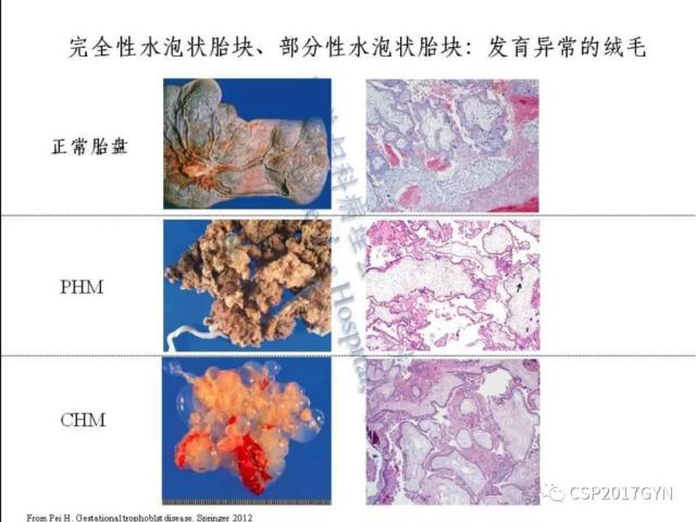 妊娠滋养细胞肿瘤的临床病理学进展