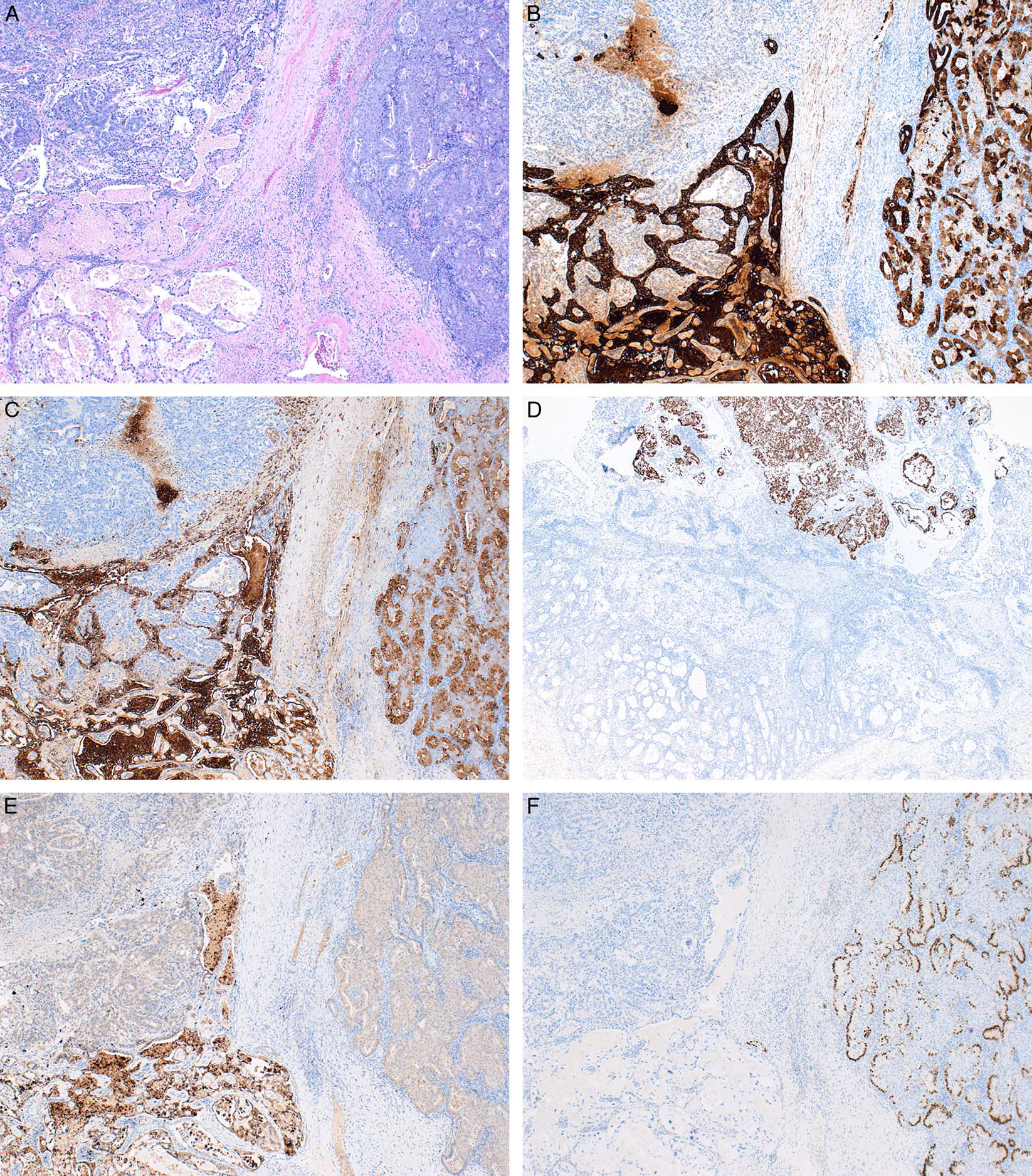 读文献，学病理-40岁以上女性恶性肿瘤中的卵黄囊瘤分化