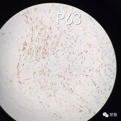 High grade nested variant Urothelial carcinoma(老胡分享，孔祥田老师讲解)