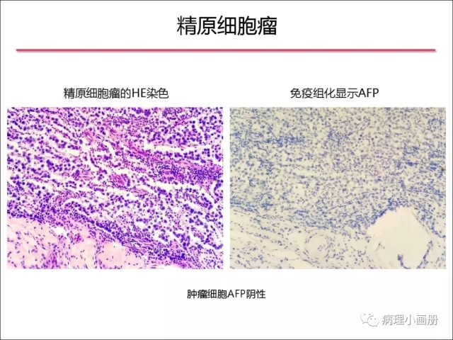 泌尿病理--精原细胞瘤VS精母细胞瘤