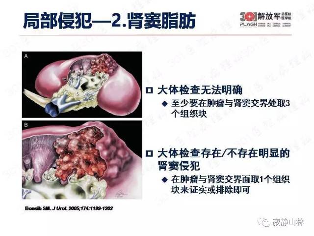 泌尿系统常见肿瘤标本病理报告规范