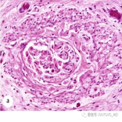 女性生殖道软组织肿瘤病理诊断及进展（二）