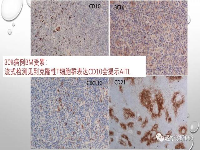 血管免疫母T细胞淋巴瘤的病理诊断