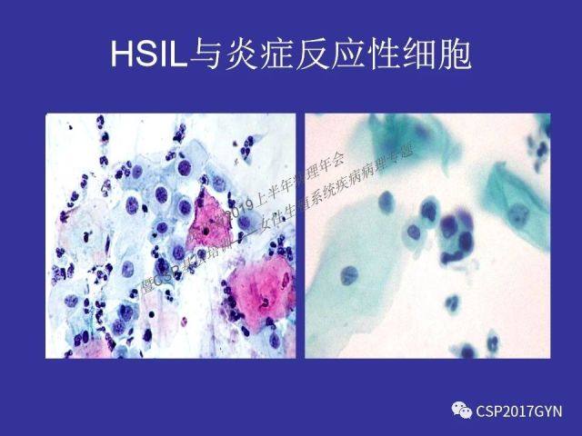 中华病理学会基层培训遵义站讲座（二）——宫颈细胞学诊断中陷阱与筛查进展