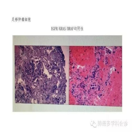EGFR基因突变检测--基础篇
