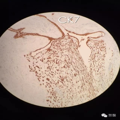 High grade nested variant Urothelial carcinoma(老胡分享，孔祥田老师讲解)