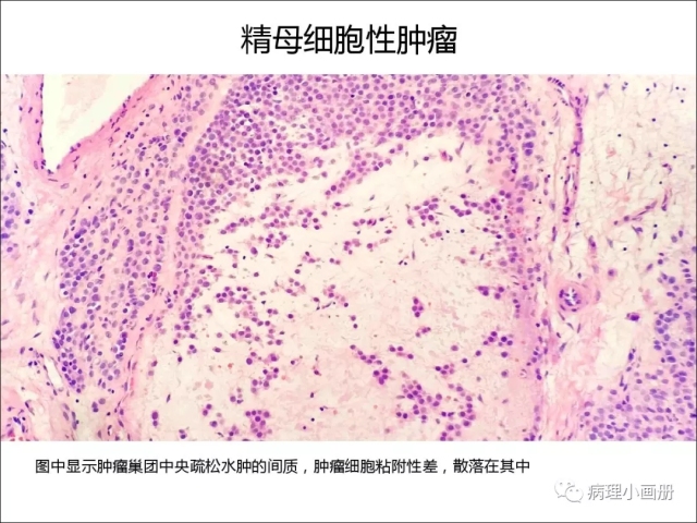 泌尿病理--精原细胞瘤VS精母细胞瘤