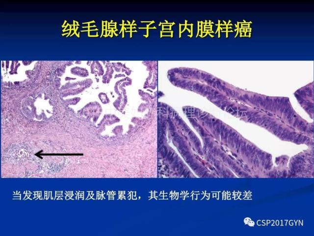 子宫内膜癌：诊断与进展