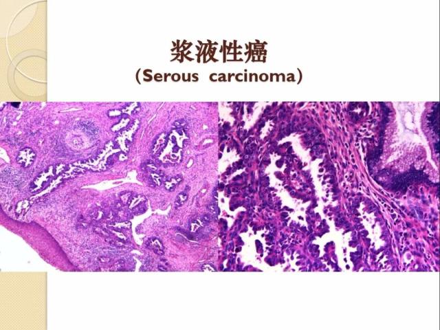 非HPV感染相关性宫颈腺性病变