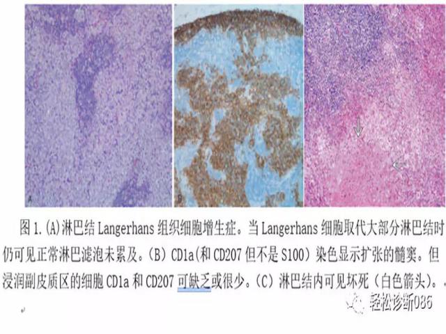组织细胞起源疾病（4）——肿瘤性病变（LCH）